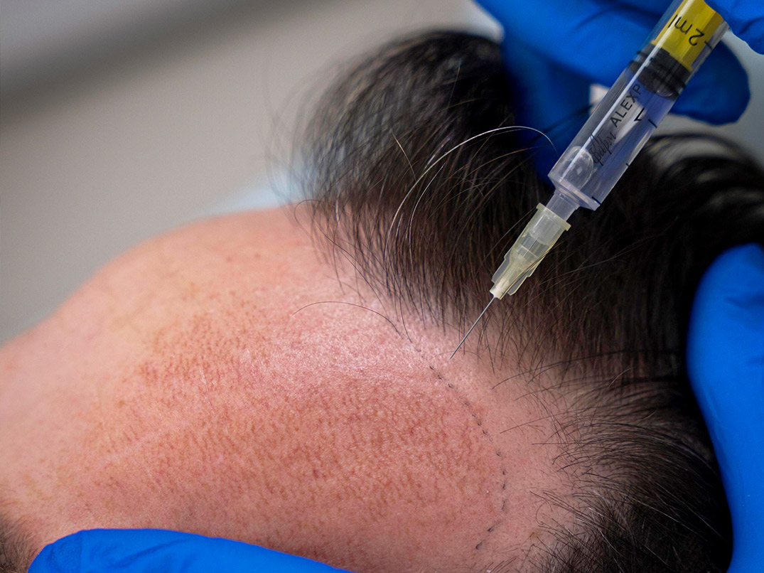 medhair durban transplant treatment
